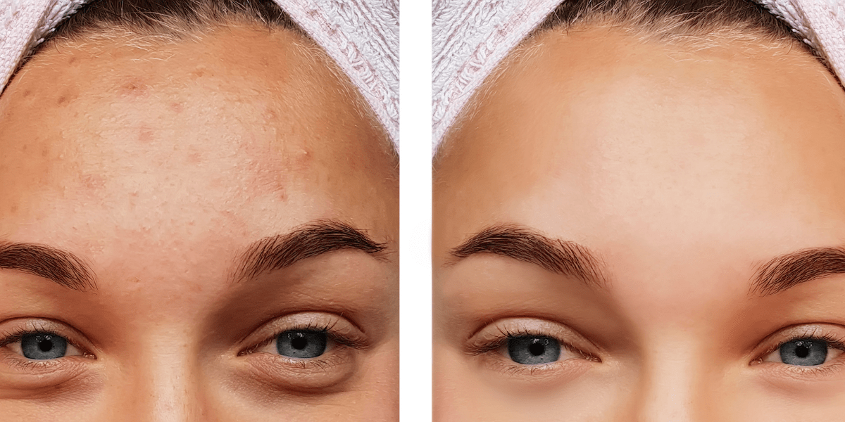 Comparison of bad skins vs good skin